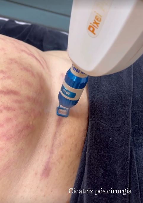 Laser em cicatriz pós-cirurgia