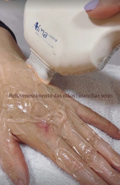 Rejuvenescimento das mãos